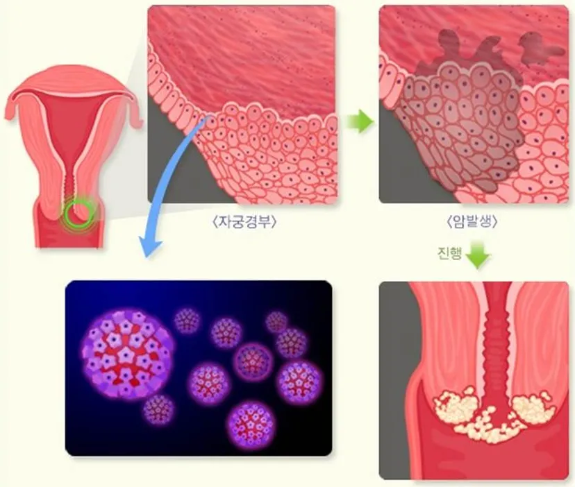 자궁경부암-발생